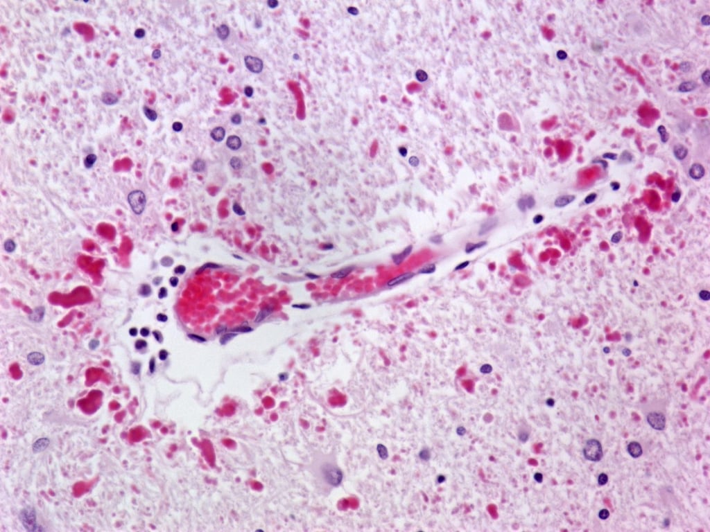 Standard histology H&E staining of tissue from an eight-year-old Alexander disease patient. Rosenthal fibers -- the hallmark of the disease -- are shown in pink; nuclei are shown in blue.